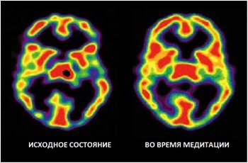 Два скана мозга автора исследования: базовое состояние и во время медитации. На томограмме хорошо видна метаболическая активность мозга: красный — наиболее активные области, черный — неактивные.
